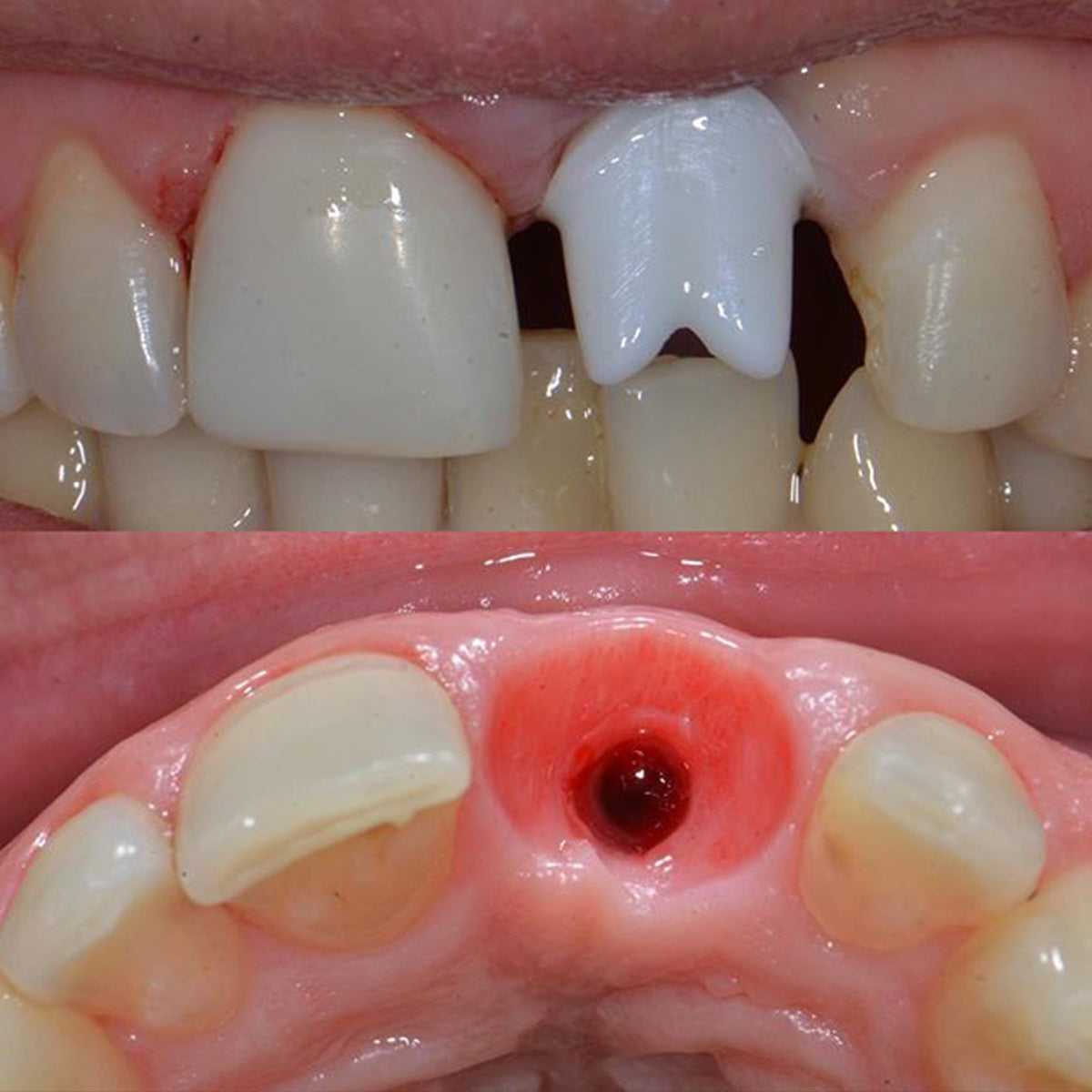 HT White Zirconia Block Sirona System 5 Pieces